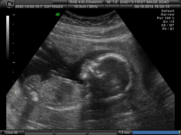 Baby Ultrasound at 18 weeks