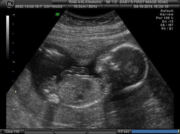 Baby Boy Ultrasound