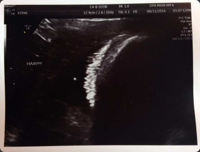 Baby's hair on ultrasound